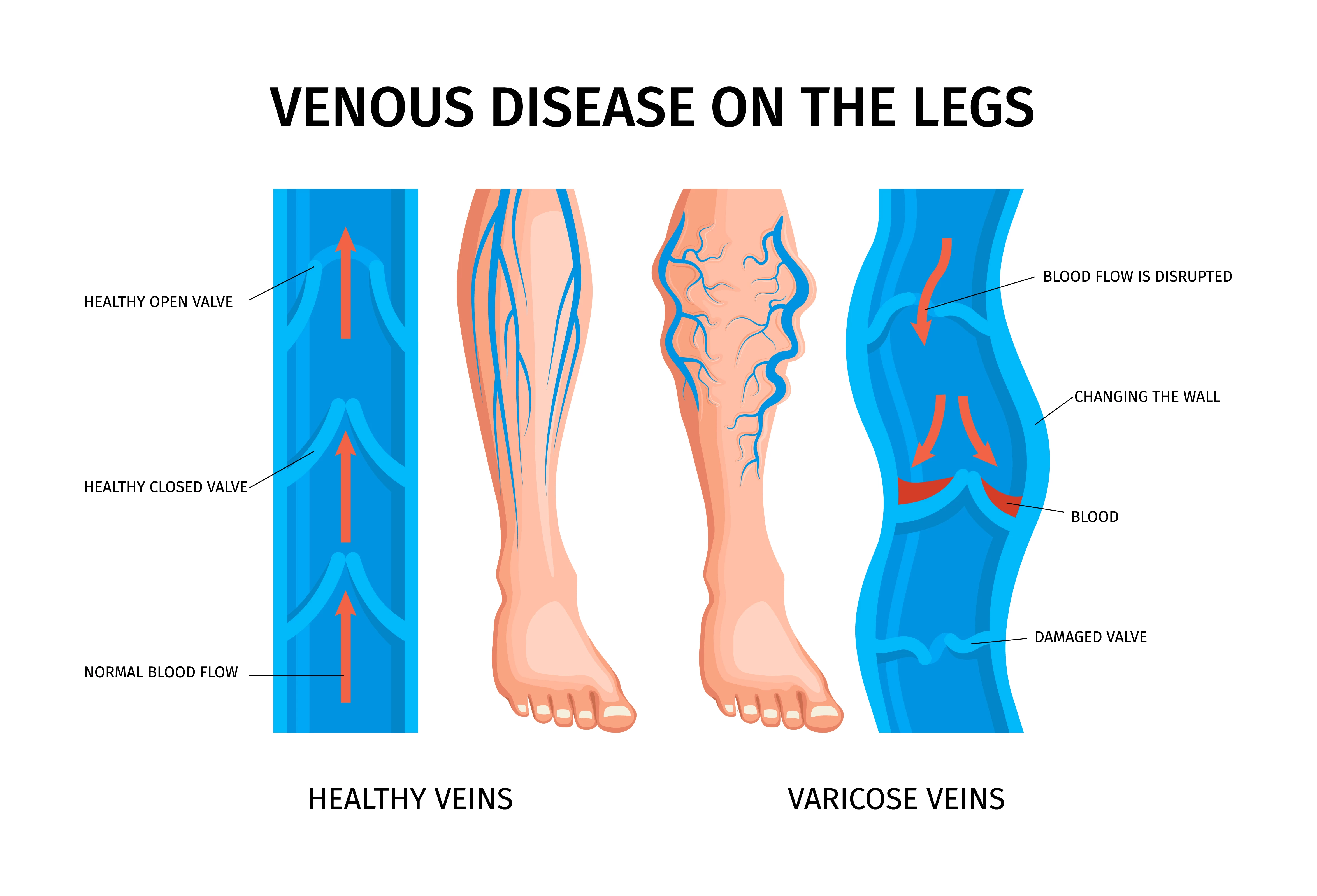 Recovery Processes After Varicose Veins Treatment - Cardiovascular
